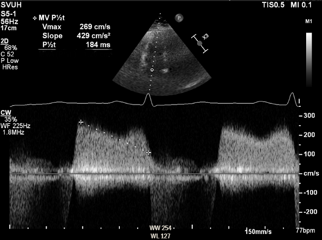 Waveform from CW Doppler interrogation of mitral valve inflow is shown below. Findings are consistent with which of the following