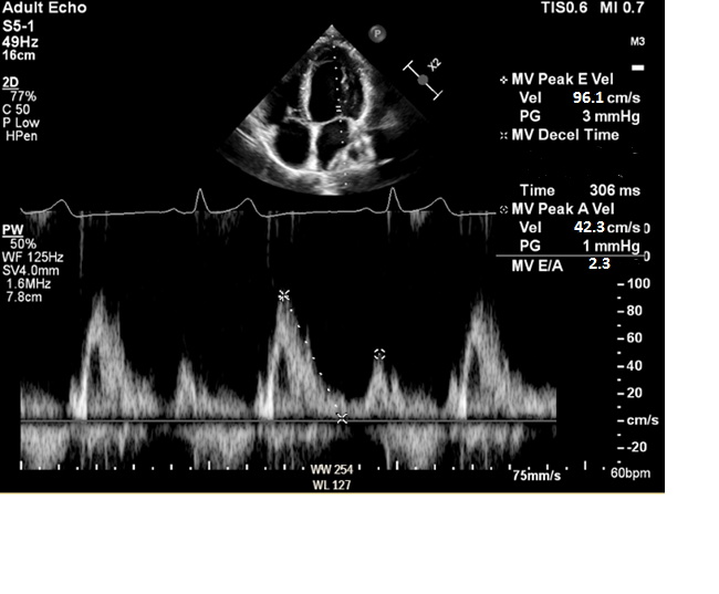 PW Doppler interrogation of mitral valve inflow is shown below. E/A ratio is consistent with which grade(s) of diastolic dysfunction: