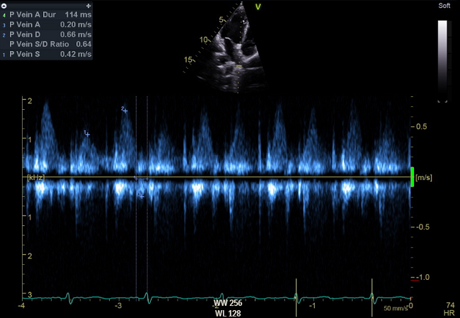 PW Doppler interrogation of pulmonary venous flow is shown below. Assuming duration of mitral inflow A wave (Adur) is 105msec, findings are suggestive of