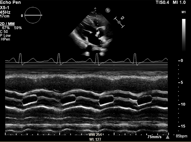 PLAX M Mode is shown below. Cursor line is placed through the aortic valve. Findings are consistent with