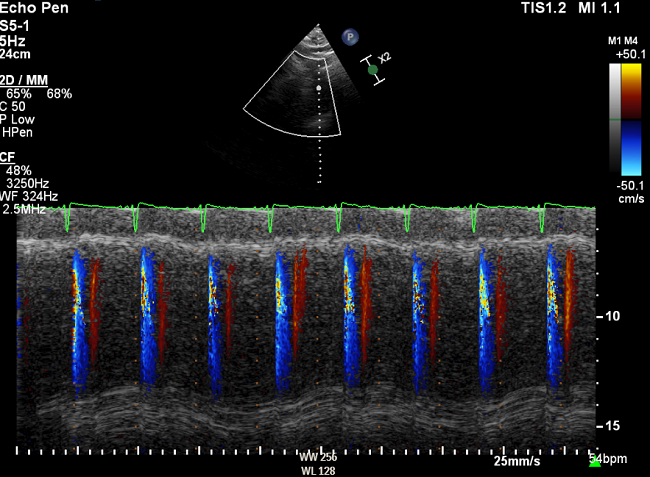 Suprasternal image is shown below. Combined colour Doppler and M mode of flow in the descending aorta is shown. Findings are consistent with