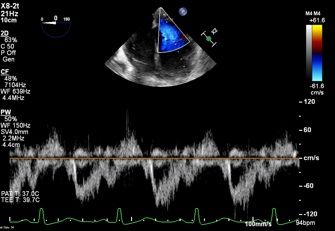 Which of the following is the most correct statement based upon imaging:<br /><br /><img class="alignnone size-medium wp-image-1495" src="https://echoexamprep.com/wp-content/uploads/2025/12/LAA-velocities-1--300x229.png" alt="" width="300" height="229" />